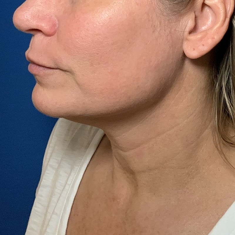 Morpheus8 Before & After